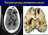 Токсоплазмоз головного мозга