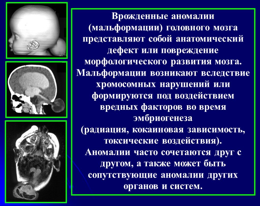 Нарушение развития головного мозга. Аномалии развития головного. Пороки развития головного мозга. Врожденные аномалии развития головного мозга. Пороки развития головного мозга у плода.