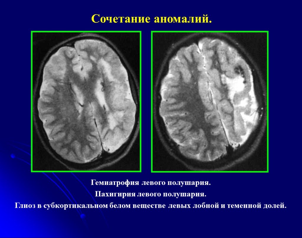Единичный очаг в левой лобной доле. Лиссэнцефалия-пахигирия. Глиоз в белом веществе лобных долей субкортикально. Глиоза полушарий головного мозга,. Глиоз головного мозга кт.