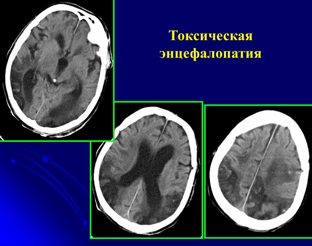 Признаки энцефалопатии мозга. Токсическое поражение головного мозга мрт. Кт головного мозга при токсической энцефалопатии. Токсическое поражение головного мозга кт. G92 токсическая энцефалопатия.