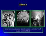 Сhiari-1. сочетание смещения заднего мозга в позвоночный канал и spina bifida