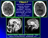 Chiari-2 через большое затылочное отверстие в большую цистерну мозга пролабируют миндалины мозжечка, червь мозжечка, продолговатый мозг, часть или весь IV желудочек и мост. комплекс пороков, поражающих позвоночник, череп, твердую мозговую оболочку, ромбовидный мозг