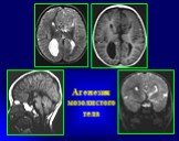 Рентгеновская компьютерная томография головного мозга Слайд: 28