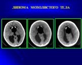 Рентгеновская компьютерная томография головного мозга Слайд: 30