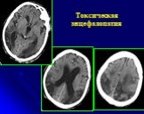 Рентгеновская компьютерная томография головного мозга Слайд: 51