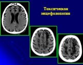 Рентгеновская компьютерная томография головного мозга Слайд: 52