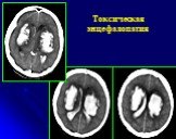 Рентгеновская компьютерная томография головного мозга Слайд: 53