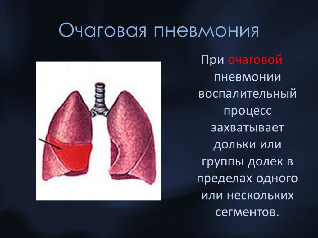 Очаговая пневмония. Внебольничная крупозная пневмония. Крупозная пневмония и очаговая пневмония. Паренхиматозная пневмония. Крупозная бронхопневмония.