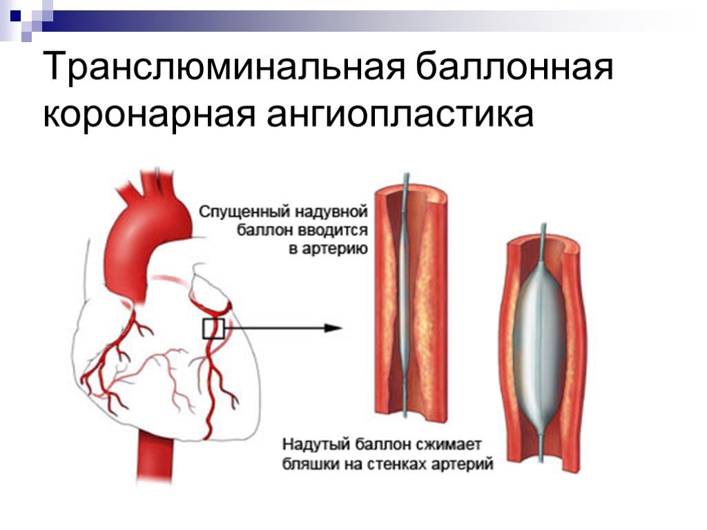 Операция ангиопластика. ТРАНСЛЮМИНАЛЬНАЯ ангиопластика коронарных артерий. Баллонная ангиопластика и стентирование. Баллонная ангиопластика сосудов сердца. Эндоваскулярное стентирование.