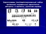 Кариограммы (систематизированный набор хромосом) нормальных кариотипов женщины и мужчины, рутинная окраска