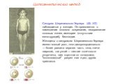 Синдром Шерешевского-Тернера (45; Х0) наблюдается у женщин. Он проявляется в замедлении полового созревания, недоразвитии половых желез, аменорее (отсутствии менструаций), бесплодии. Женщины с синдромом Шерешевского-Тернера имеют малый рост, тело диспропорционально — более развита верхняя часть тела