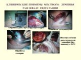 КЛИНИЧЕСКИЕ ПРИМЕРЫ МЕСТНОГО ЛЕЧЕНИЯ РАН В ФАЗУ ГИДРАТАЦИИ. Обработка раны пульсирующей струей. Обработка ультразвуком. Обработка лазером. Местное лечение раны открытым способом (без повязок) в АСУ.