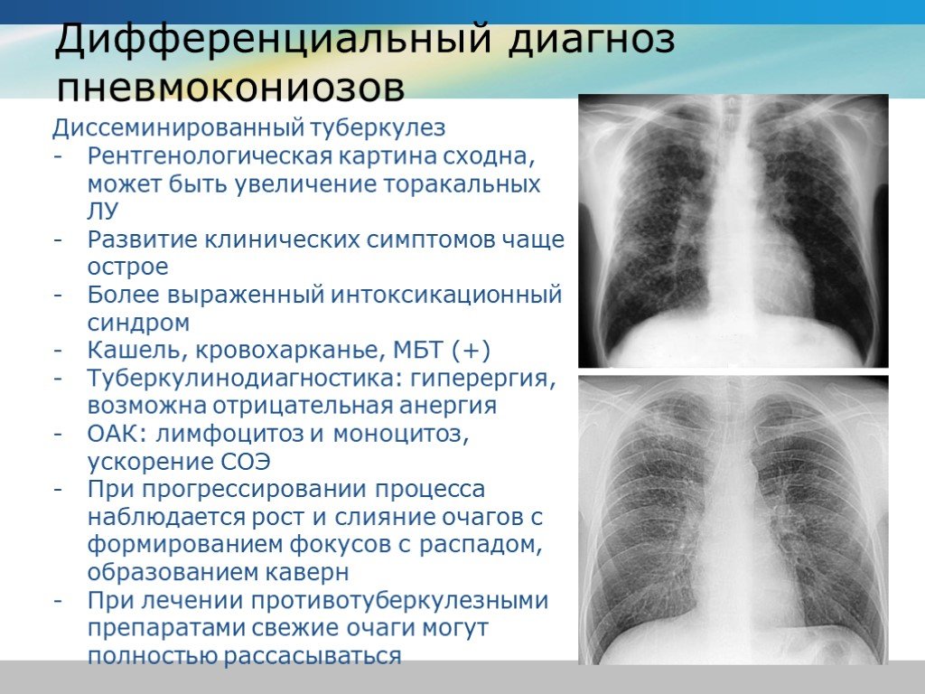 Диссеминированный туберкулез фаза инфильтрации. Диссеминированный туберкулез. Диссеминированный инфильтративный туберкулез. Диагноз диссеминированный туберкулез легких.