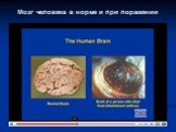 Мозг человека в норме и при поражении