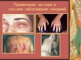 Проявления на коже в случаях заболевания гонореей