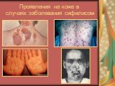 Проявления на коже в случаях заболевания сифилисом