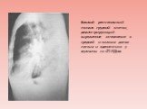 Боковой рентгеновский снимок грудной клетки, демонстрирующий выраженное затемнение в средней и нижних долях легких и аденопатию у мужчины со СПИДом.