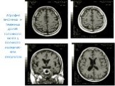 Атрофия височных и теменных долей головного мозга у больного ишемичес-ким инсультом