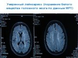 Умеренный лейкоареоз (поражение белого вещества головного мозга по данным МРТ)