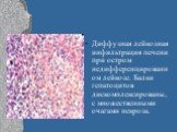 Диффузная лейкозная инфильтрация печени при остром недифференцированном лейкозе. Балки гепатоцитов дискомплексированы, с множественными очагами некроза.
