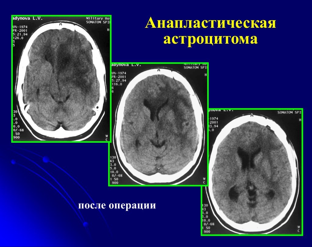 Астроцитома головного мозга прогноз. Кт-цистернография методика. Астроцитома лобной доли. Анапластическая астроцитома. Анапластическая астроцитома кт.