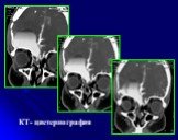 Рентгеновская КТ головного мозга Слайд: 26