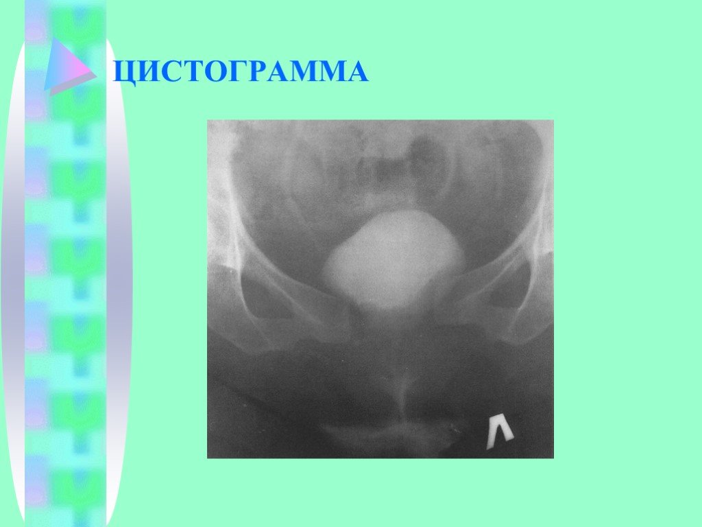 Семиотика урологических заболеваний презентация