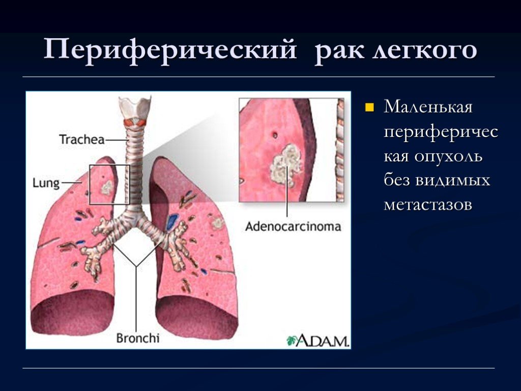 Стадии рака бронха. Периферические опухоли легких. Периферическая опухоль легкого. Центральная опухоль легкого.