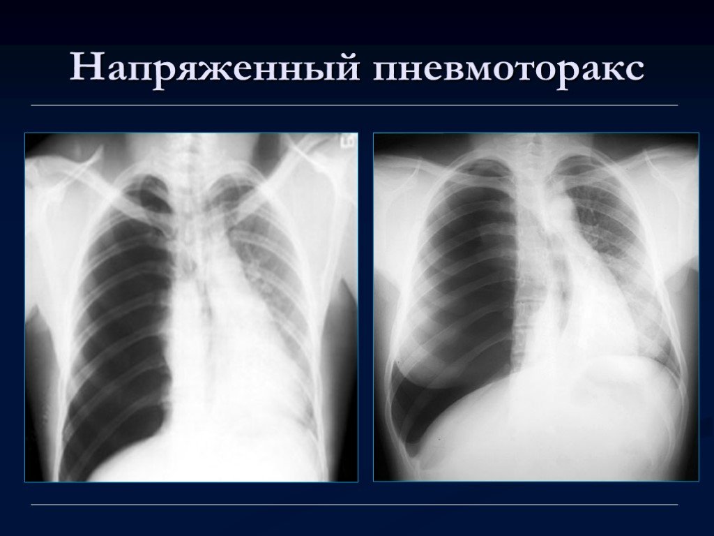 Напряженный пневмоторакс. Напряженный пневмоторакс рентген. Пневмоторакс рентген. Тотальный пневмоторакс рентгенограмма. Клапанный напряженный пневмоторакс рентген.