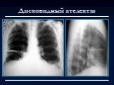 Лучевая диагностика заболеваний органов дыхания Слайд: 65