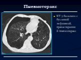 Пневмоторакс. КТ у больного с буллезной эмфиземой, правосторонний пневмоторакс