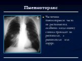 Частичные пневмотораксы часто не распознаются, особенно когда оценку снимка проводит не рентгенолог, а реаниматолог или хирург.