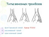 Типы венозных тромбозов. а – флоттирующий тромб. Угроза ТЭЛА! б – окклюзивный тромб в – пристеночный тромб
