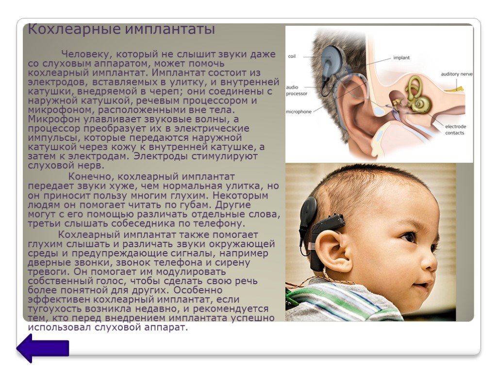 Какие приспособления помогают глухим людям. Аппарат слуховые аппараты при тугоухости 3. Тугоухость кохлеарная имплантация. Кохлеарный слуховой аппарат. Кохлеарный имплант аппарат.