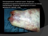 Клостридиальная инфекция культи бедра при неадекватном уровне ампутации конечности по поводу ишемической гангрены: характерная пятнисто-мраморная окраска кожи