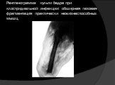 Рентгенограмма культи бедра при клостридиальной инфекции: обширная газовая фрагментация практически нежизнеспособных мышц.