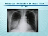 Крупозды пневмония кезіндегі өкпе суреті