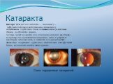 Катаракта. Катара́кта (от лат. cataracta — "водопад") — офтальмологическое заболевание, связанное с помутнением хрусталика глаза и вызывающее различные степени расстройства зрения. Болезнь может развиться под влиянием внешних факторов, например под воздействием излучения, либо в результате