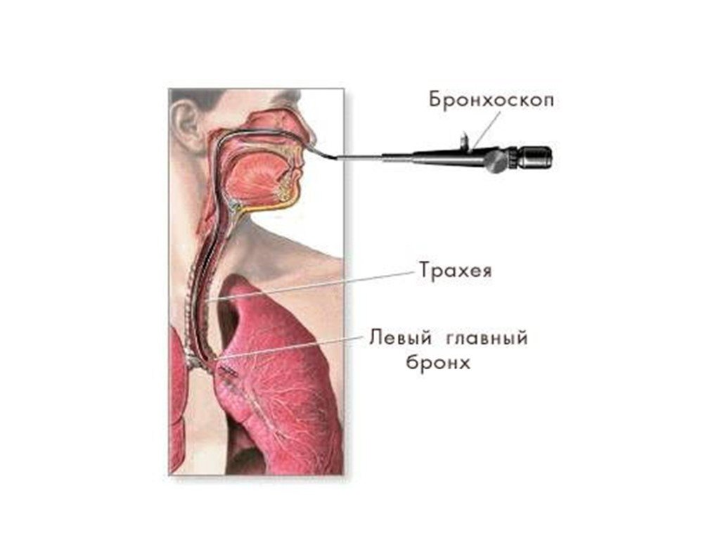 Жесткое трахеи. Ригидная бронхоскопия. Туберкулез бронхов бронхоскопия. Интубационный бронхоскоп.