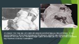 29 апреля 1961 года врач 6-й Советской антарктической экспедиции Леонид Рогозов, 27 лет диагностировал у себя острый аппендицит. Поскольку он оказался единственным врачом на полярной станции, ночью, 30 апреля хирург сделал себе операцию сам, под местной анестезией. Ему помогали инженер и метеоролог.