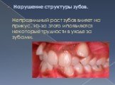 Нарушение структуры зубов. Неправильный рост зубов влияет на прикус. Из-за этого и появляются некоторые трудности в уходе за зубами.