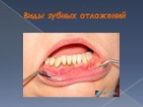 Виды зубных отложений