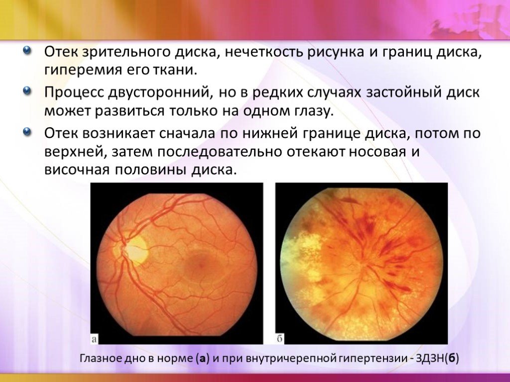 Норма зрительного нерва. Офтальмоскопия диска зрительного нерва. Отек диска зрительного нерва офтальмоскопия.