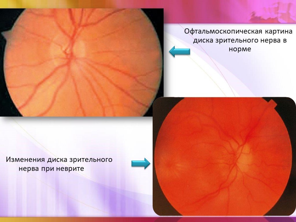Норма зрительного нерва. Интрабульбарный неврит зрительного нерва. Оптический неврит папиллит. Неврит зрительного нерва офтальмоскопия. Неврит зрительного нерва глазное дно.