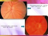 Офтальмоскопическая картина диска зрительного нерва в норме. Изменения диска зрительного нерва при неврите