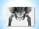 Таз ніби здавлений в бокових проекціях. Стегнова кістка має невеликих розмірів голівку, що сприяє вивихам і підвивихам голівки стегнової кістки. Діафізи трубчастих кісток і кістково мозкові канали розширені, кортикальний шар зтоншений.