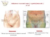Бедренно-половой нерв ( n.genitofemoralis ) L1-L2. Пересечение. Потеря чувствительности в области кожной иннервации. Сдавление. Нейропатия . Восстановление от 3 до 12 месяцев
