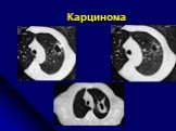 Диференциальная диагностика шаровидных образований лёгких Слайд: 10