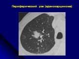 Диференциальная диагностика шаровидных образований лёгких Слайд: 12