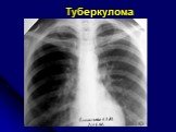 Диференциальная диагностика шаровидных образований лёгких Слайд: 24
